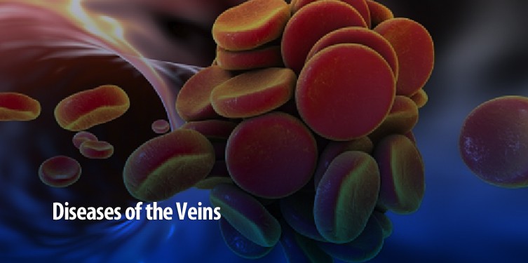 Diseases-of-the-veins-MD-DC-PA