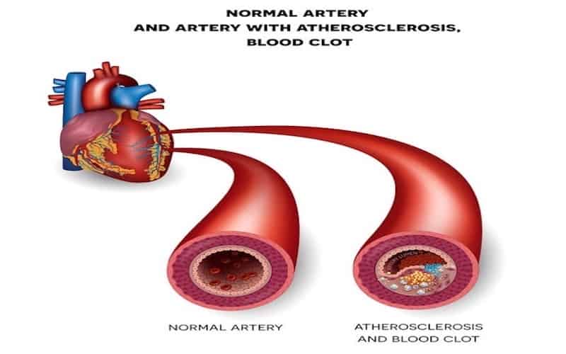normal artery and artery with atherosclerosis blood clot