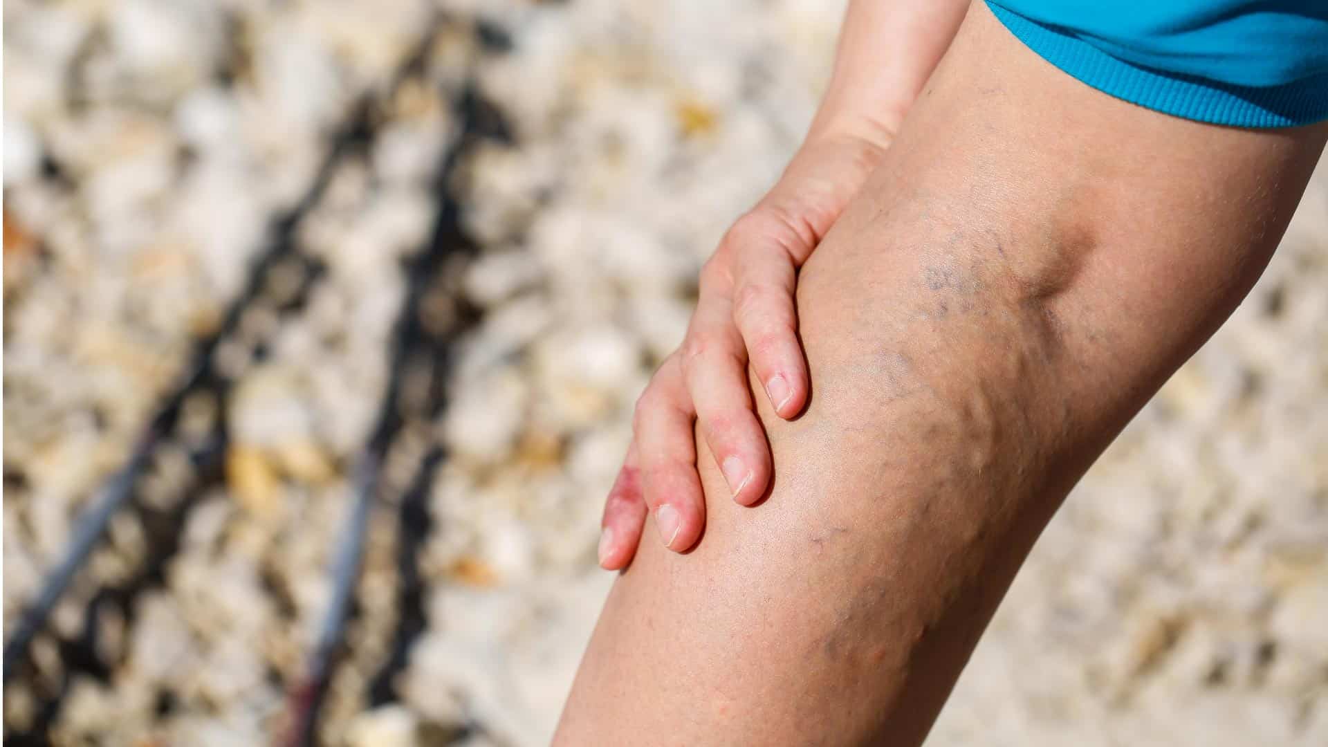 Leg Pain Upper Lower Leg Pain Maryland Vascular Specialists