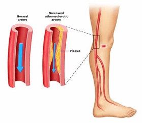 pad symptoms