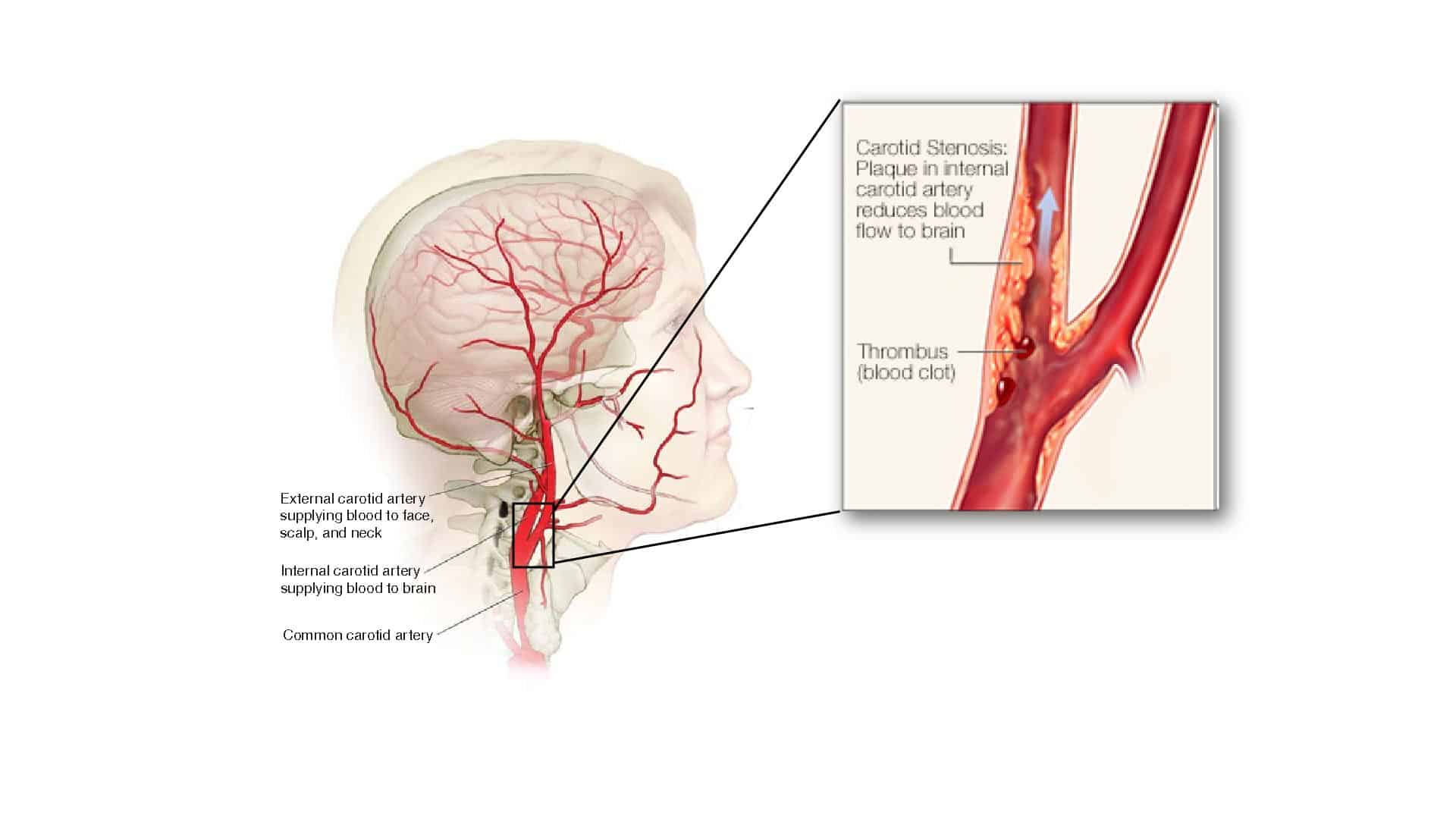 cartoid stenosis diagram - Maryland Vascular Specialists