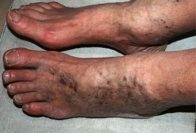 the feet of a patient suffering from Chronic Veinous Insufficiency - Maryland Vascular Specialists
