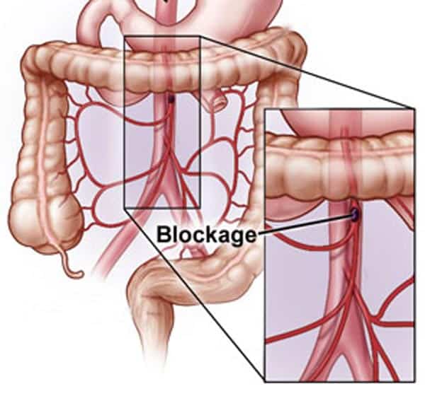 Mesenteric Artery Ischemia diagram - Maryland Vascular Specialists