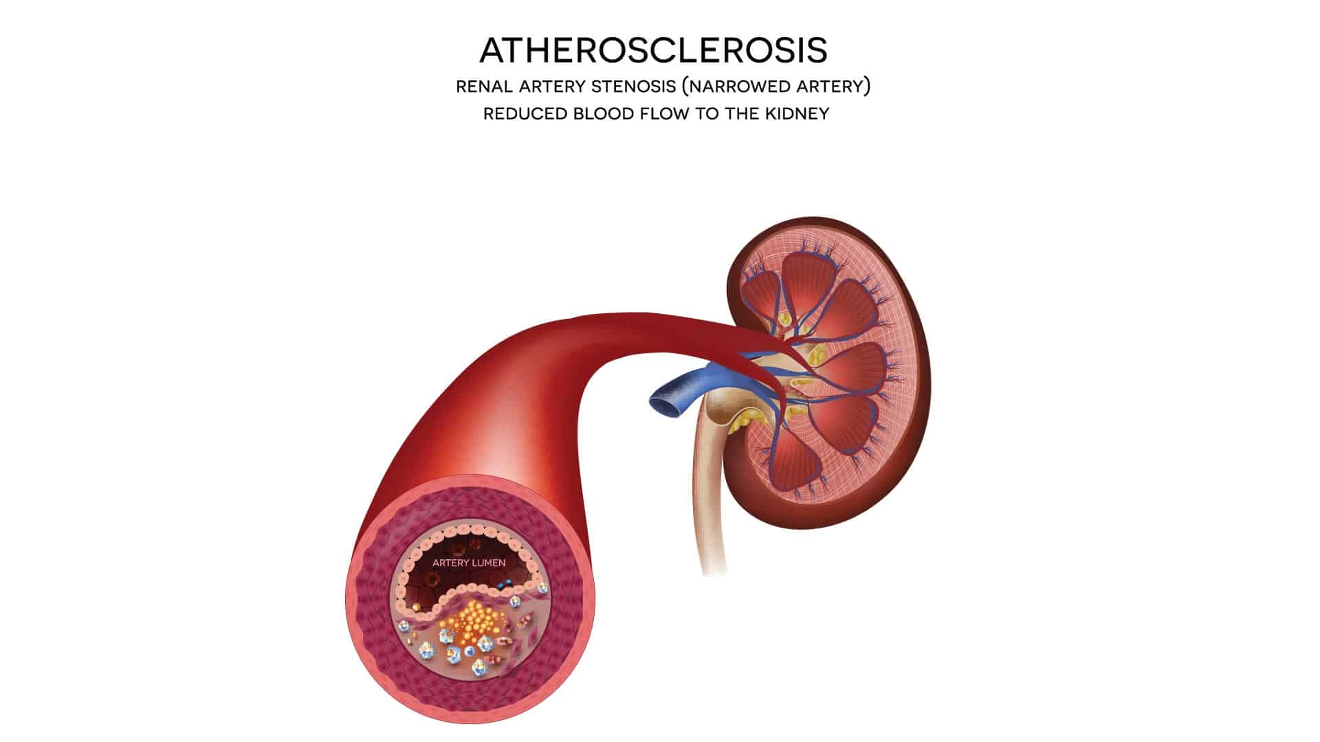 atherosclerosis diagram - Maryland Vascular Specialists