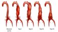 Abdominal Aortic Disease | Maryland Vascular Specialists