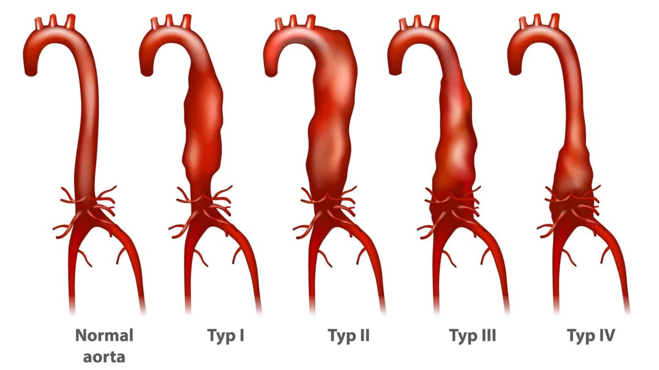 Aorta oh слив фото